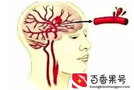 卒中中心是干什么的