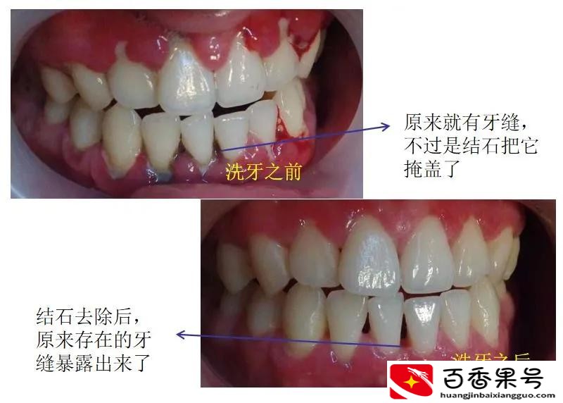 到底该不该洗牙，听听专业医生怎么说