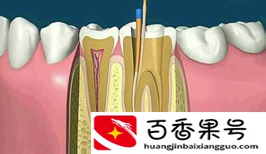 良心医生不建议拔智齿